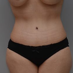 Abdominoplasty Before & After Patient #3443