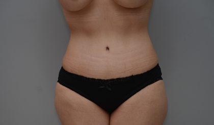 Abdominoplasty Before & After Patient #3443
