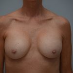 Breast Implant Exchange Before & After Patient #3455