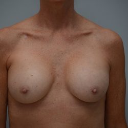 Breast Implant Exchange Before & After Patient #3455