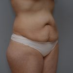 Abdominoplasty Before & After Patient #3443
