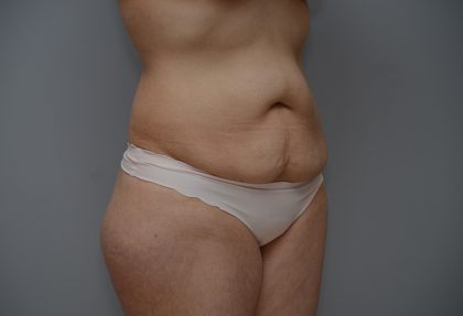 Abdominoplasty Before & After Patient #3443