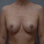 Breast Augmentation Before & After Patient #3389