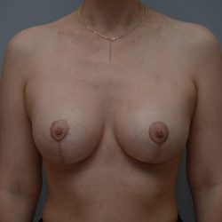 Breast Augmentation Before & After Patient #3389