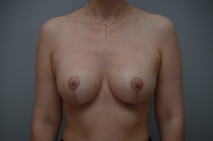 Breast Augmentation Before & After Patient #3389