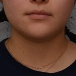 Neck Liposuction Before & After Patient #3467