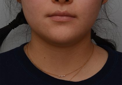 Neck Liposuction Before & After Patient #3467