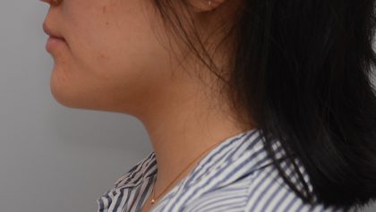 Neck Liposuction Before & After Patient #3467