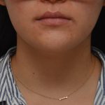 Neck Liposuction Before & After Patient #3467