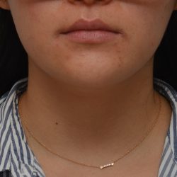 Neck Liposuction Before & After Patient #3467