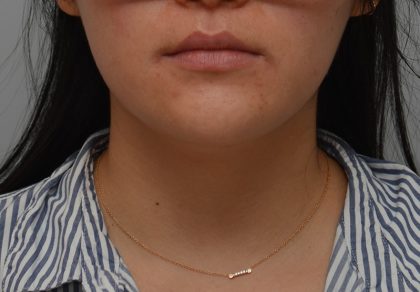 Neck Liposuction Before & After Patient #3467