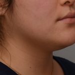 Neck Liposuction Before & After Patient #3467