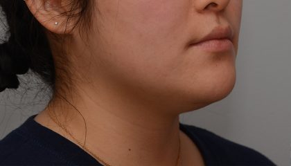 Neck Liposuction Before & After Patient #3467
