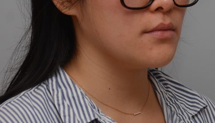Neck Liposuction Before & After Patient #3467