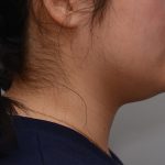 Neck Liposuction Before & After Patient #3467