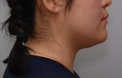 Neck Liposuction Before & After Patient #3467