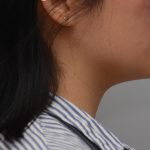 Neck Liposuction Before & After Patient #3467