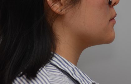Neck Liposuction Before & After Patient #3467