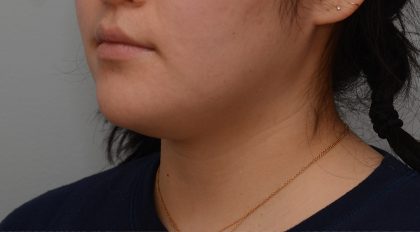 Neck Liposuction Before & After Patient #3467
