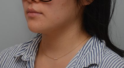 Neck Liposuction Before & After Patient #3467