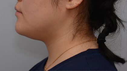 Neck Liposuction Before & After Patient #3467