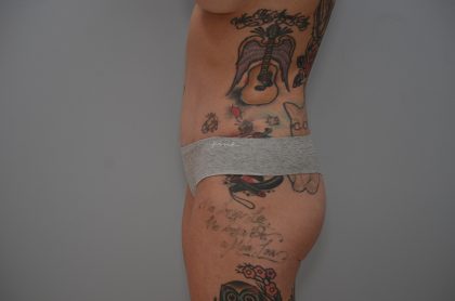 Abdominoplasty Before & After Patient #3478