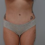Abdominoplasty Before & After Patient #3478