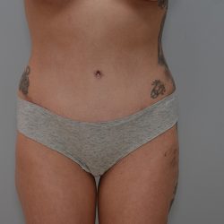 Abdominoplasty Before & After Patient #3478