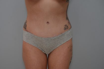 Abdominoplasty Before & After Patient #3478