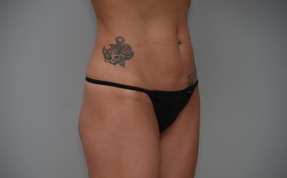 Abdominoplasty Before & After Patient #3478
