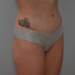Abdominoplasty Before & After Patient #3478