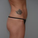Abdominoplasty Before & After Patient #3478