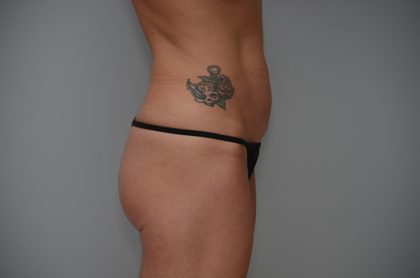 Abdominoplasty Before & After Patient #3478