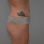 Abdominoplasty Before & After Patient #3478
