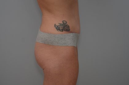 Abdominoplasty Before & After Patient #3478