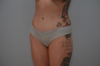 Abdominoplasty Before & After Patient #3478