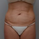 Abdominoplasty Before & After Patient #3489