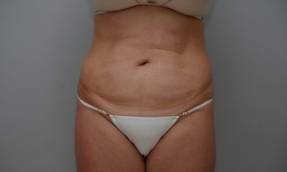 Abdominoplasty Before & After Patient #3489