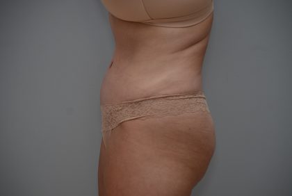 Abdominoplasty Before & After Patient #3489