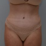 Abdominoplasty Before & After Patient #3489