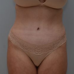 Abdominoplasty Before & After Patient #3489