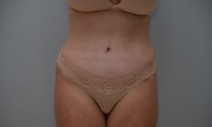 Abdominoplasty Before & After Patient #3489