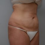 Abdominoplasty Before & After Patient #3489