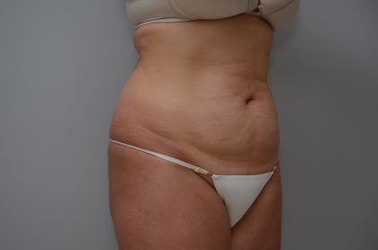 Abdominoplasty Before & After Patient #3489