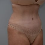 Abdominoplasty Before & After Patient #3489