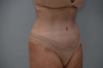Abdominoplasty Before & After Patient #3489