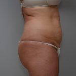 Abdominoplasty Before & After Patient #3489