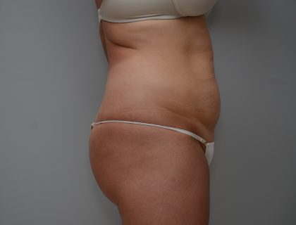 Abdominoplasty Before & After Patient #3489