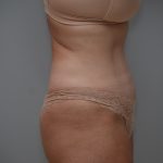 Abdominoplasty Before & After Patient #3489