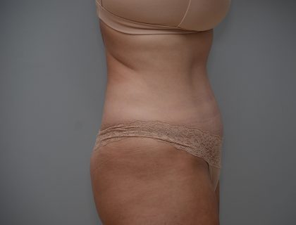 Abdominoplasty Before & After Patient #3489